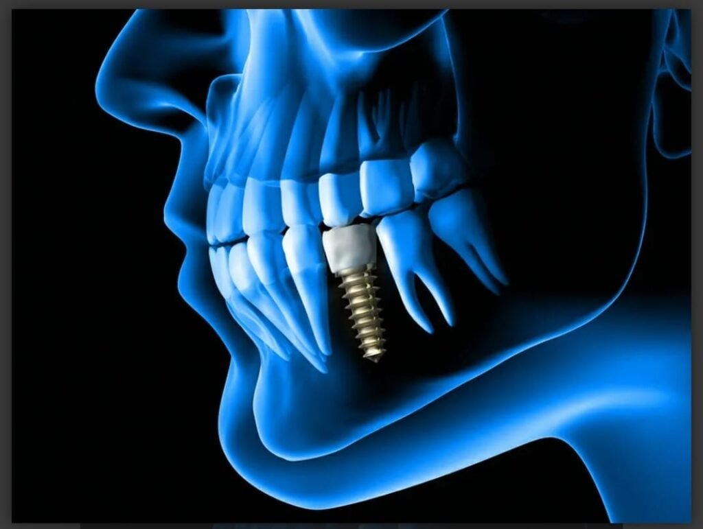 Dental Implant 1024x771 1